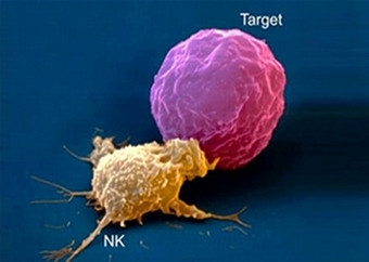 NKM_ Liệu pháp tế bào miễn dịch chống ung thư