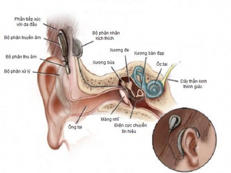 ỐC tai điện tử Cochlear