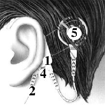 ỐC tai điện tử Cochlear